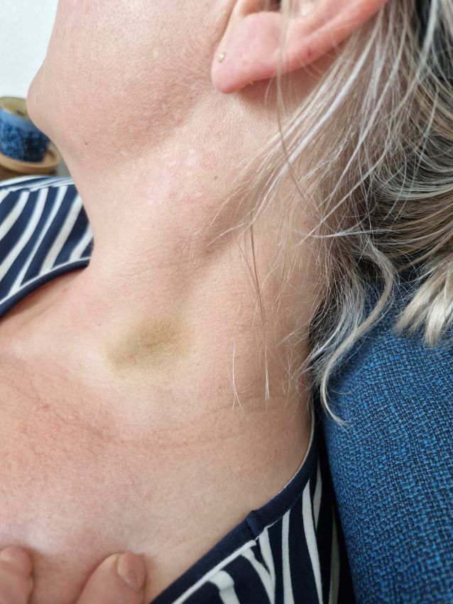 Nekartrose blog - Blauwe plek als gevolg van pijnblokkade - Rina van Loenen - nekartrose-pijnklachten-fibromyalgie-osteoporose