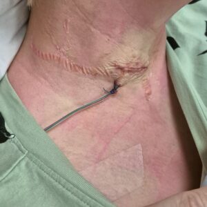 Nekartrose blog - Nekoperatie dag 1 - Rina van Loenen - nekartrose-pijnklachten-fibromyalgie-osteoporose