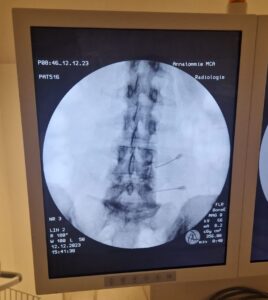 Nekartrose blog - Röntgen blokkade rug - Rina van Loenen - nekartrose-pijnklachten-fibromyalgie-osteoporose