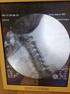 Nekartrose blog - rontgefoto Pijnblokkade nek - Rina van Loenen - nekartrose-pijnklachten-fibromyalgie-osteoporose